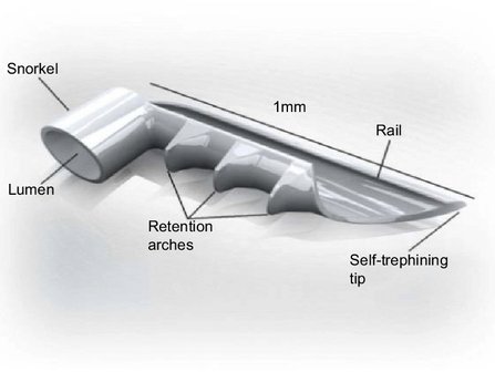 Two-Year Multicenter Outcomes of iStent inject Trabecular Micro-Bypass Stents